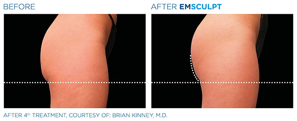 Emsculpt Before and After
