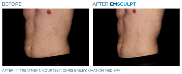 Emsculpt Before and After