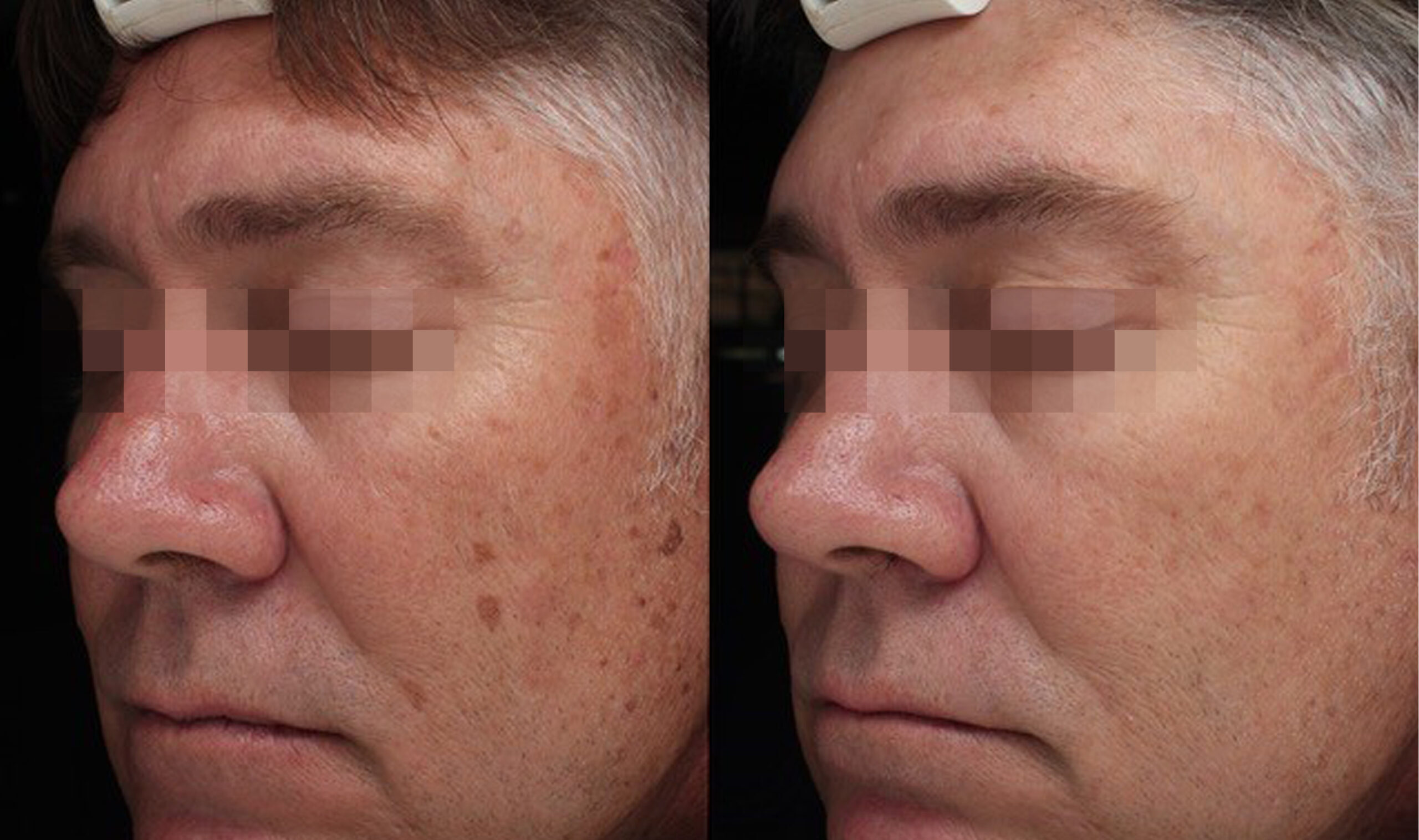 Men Before & After Treatment
